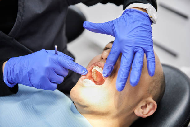 Best Knocked-Out Tooth (Avulsed Tooth) Treatment in Saratoga, CA